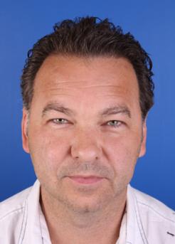 After Hair Transplant&nbsp;Temporal Hairline